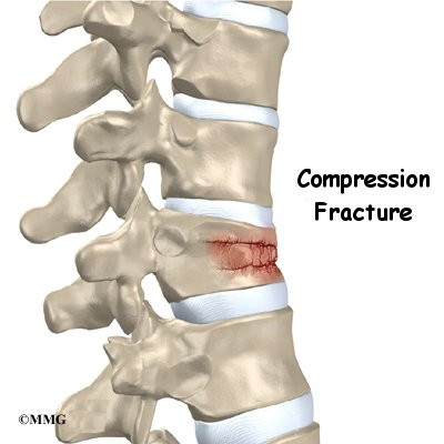 <p>Bone is crushed i.e., osteoporotic bones (common in porous bones)</p>