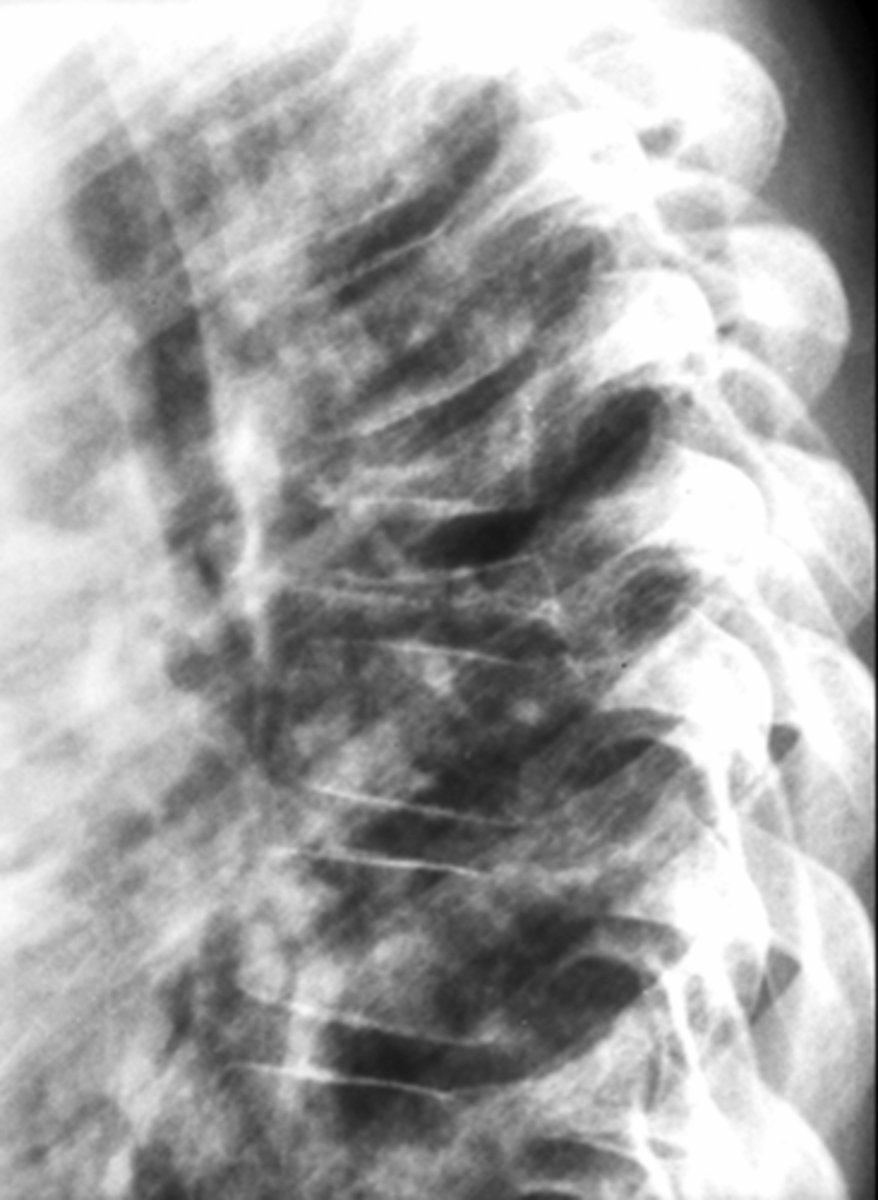 <p>Pathologic vertebral body collapse</p>
