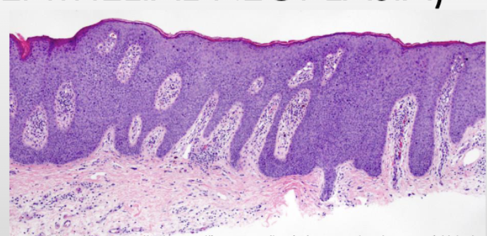 <p>Penile high grade squamous intraepithelial lesion</p>