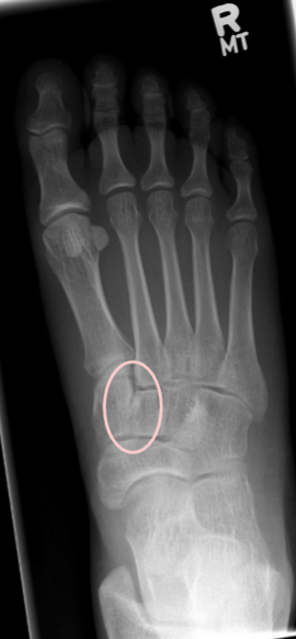<ul><li><p>less than 1/3 SI of talar head by calc</p></li><li><p>intercuneiform joint closed</p></li><li><p>navicular cuneiform is more SI</p></li><li><p>2-5 MT bases less SI</p></li></ul><p></p>