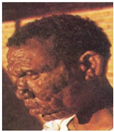 <ul><li><p>grows in foot pad of <strong>armadillo or mouse</strong> (cannot grow in agar/culture—&gt; requires living host!!!!!)</p></li><li><p>causes:</p><ul><li><p>tuberculoid<strong> LEPROSY—&gt; patchy anesthesia</strong></p></li><li><p>lepromatous <strong>LEPROSY—&gt; severe</strong>, contagious, cell-mediated immunity defective</p></li></ul></li><li><p>tx: <strong>DAPASONE</strong>—&gt; take long term</p></li></ul><p></p>