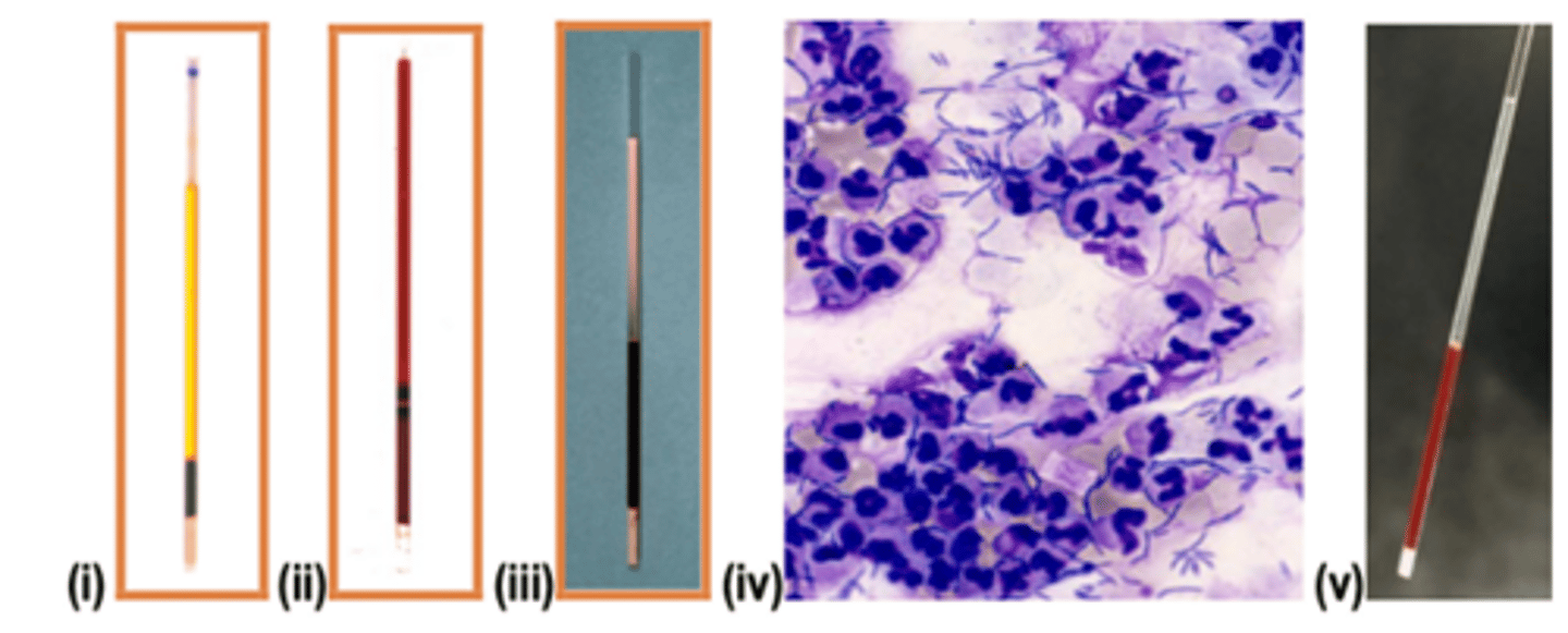 <p>Which condition is most consistent with intravascular hemolysis due to onion poisoning?</p>