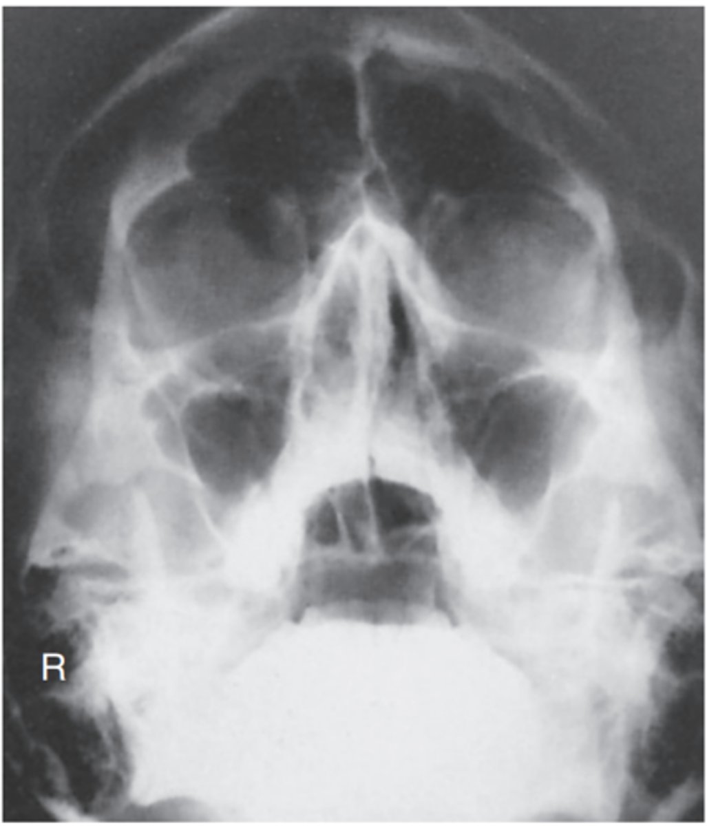 <p>-Position: No rotation of the cranium is indicated by the following: equal distance from the MSP (identified by the bony nasal septum) to the lateral orbital margin on both sides; equal distance from the lateral orbital margin to the lateral cortex of the cranium on both sides; accurate extension of the neck demonstrating petrous ridges just inferior to the maxillary sinuses</p>