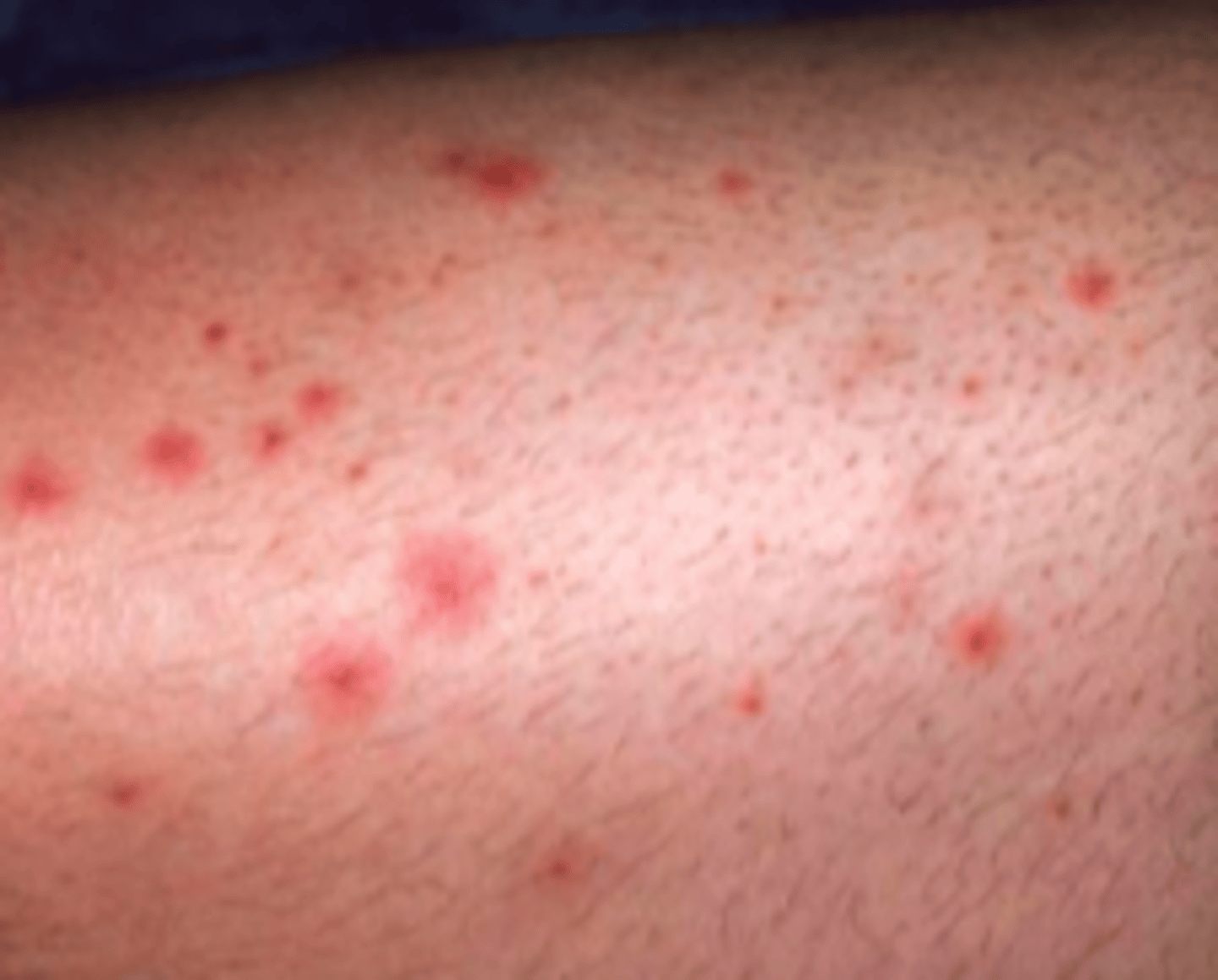 <p>Bacterial ID:</p><p>Overview:</p><p>- Bacterial infection</p><p>- Commonly: S. aureus (gram +) and gram-negative bacteria</p><p>- Can occur in infants, children, or adults</p><p>Risk factors:</p><p>- Nasal carriage of S. aureus</p><p>- Hyperhidrosis</p><p>- Occlusion of hair follicles</p><p>- Shaving</p>