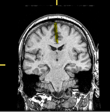 <p>What part of the brain is highlighted?</p>