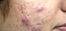 <p>acne cicatricial</p>