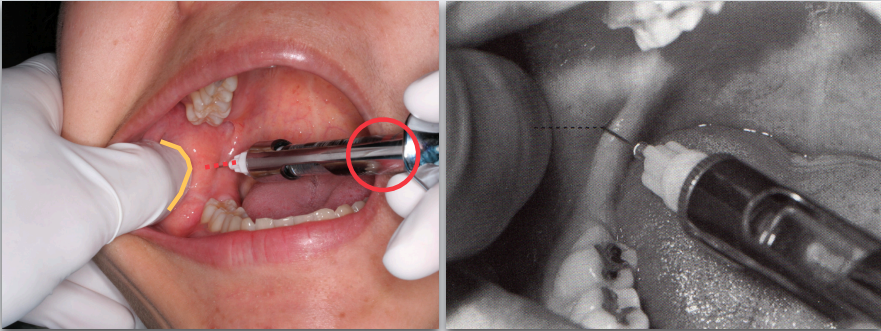 <ol><li><p>Come in from the contralateral side between the premolar area </p></li><li><p>Slowly advance until bone is contacted</p></li></ol><p></p>