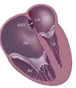 <p><span>_________________occurs as a baby develops in the womb. The exact cause is unknown. The use of certain drugs (such as lithium or benzodiazepines) during pregnancy may play a role. The condition is rare.</span></p>