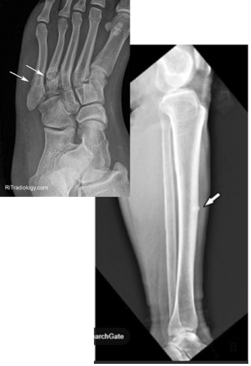 <p>Caused by a repeated stress on the bone (marchers or runners)</p>