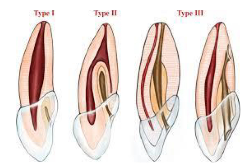 <p>1- invagination limited to crown- not beyond CEJ</p><p>2- extends beyond CEJ, may/not communicate with pulp&nbsp;</p><p>3- extends through root- no communication with pulp&nbsp;</p>