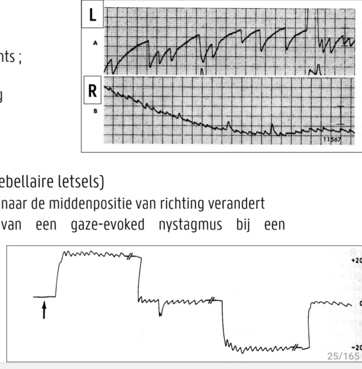 <p>uitzonderingen!</p><p>Brun’s nystagmus (cerebellaireletsels)</p><ul><li><p>Naar rechts kijken: nystagmus naar rechts ; <br>Naar links kijken: nystagmus naar links</p></li><li><p><strong><u>Asymmetrisch</u></strong>: nystagmus in derichting<br>van het letsel is heviger<br></p></li></ul><p>Rebound nystagmus (hersenstam of cerebellaireletsels)</p><ul><li><p>Horizontale nystagmus die bij refixatie naar de middenpositievan richting verandert</p></li><li><p>&nbsp;Uitdoving of richtingsverandering van een gaze-evoked nystagmus bij een aangehouden oculaire deviatie</p></li><li><p>&nbsp;Zeer kleine nystagmusslagen</p></li><li><p>kijk nr links → terug nr midden (richting vernadering plots) etc</p></li></ul><p></p>