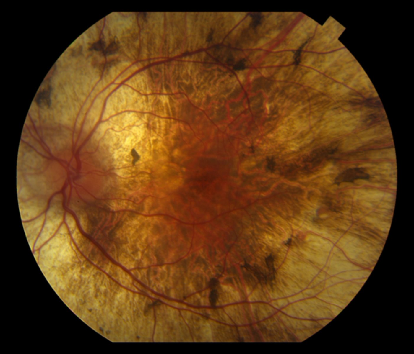 <p>VF = patchy midperipheral irregular scotomas, then near complete loss of central and peripheral vision later on</p><p>ERG = abnormal</p><p>genetic testing</p>