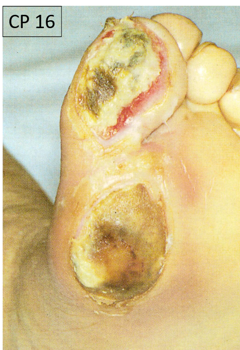 <p>Pathogenesis: metabolic and ischaemic damage to nerves due to thickening of endoneurial arterioles from diabetes</p><p>Signs:</p><ul><li><p>Distal, symmetrical polyneuropathy: numbness, loss of pain sensation</p></li><li><p>Autonomic neuropathy: disturbances in bladder and bowel function</p></li></ul><p></p><p>Complications: can lead to infection and amputation</p><p></p>