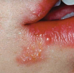 <p>generalized gingivitis may occur</p><p>primary infection is often <span style="color: red;">subclinical</span></p><p>lesions usually <span style="color: red;">resolve in 10-14 days</span> without a trace</p><p>oral lesions are widespread with <span style="color: red;">small vesicles</span> forming <span style="color: red;">anywhere on the lips and mucosa</span></p><ul><li><p><strong>triggers:</strong></p><ul><li><p>stress, strong sunlight exposure, or immune suppression</p></li></ul></li></ul><ul><li><p><strong>recurrent infection</strong></p><ul><li><p>recurring painful intraoral episodes may require <span style="color: red;">antiviral medication</span></p></li><li><p>vesicles are short-lived; <span style="color: red;">ulcers are discrete </span>and typically <span style="color: red;"><span>smaller than 2mm</span></span></p></li><li><p>usually<span style="color: red;"> less severe</span>; lesions occur <span style="color: red;">only on keratinized tissue</span> (perioral skin, gingiva, hard palate)</p></li></ul></li></ul><p></p>