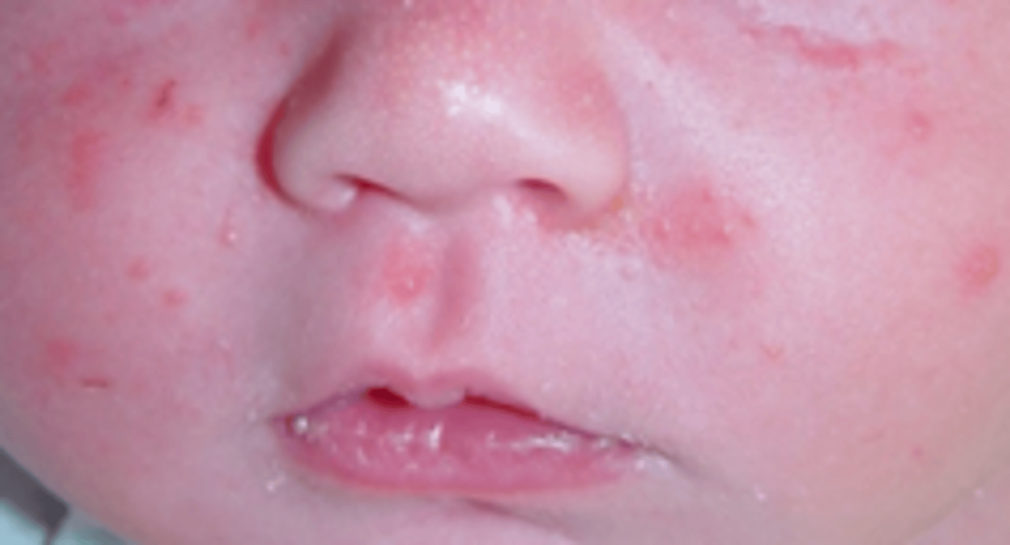<p>first 2-4wks of life</p><p>papules and pustules (NO COMEDOMES)</p>