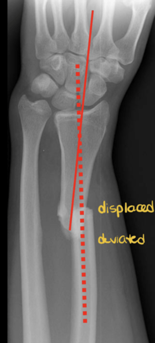 <p>Angular relationship; one fragment to another; abnormality = deviation</p>