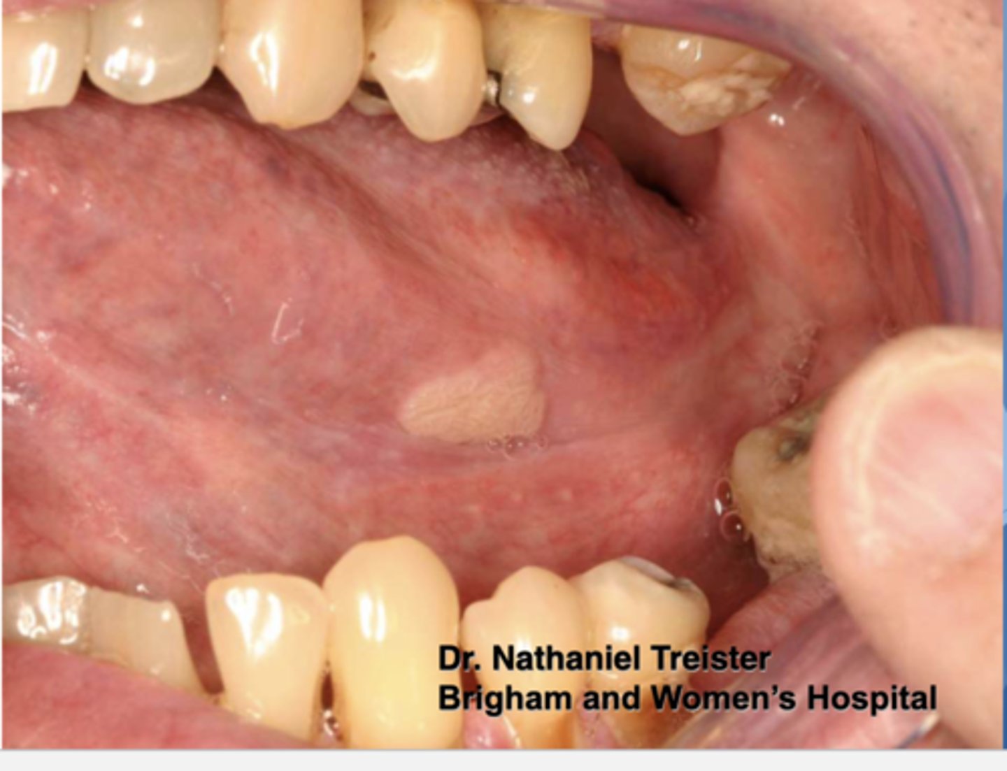 <p>Pt presents with this papillary lesion but is negative for HPV. What do you suspect?</p>