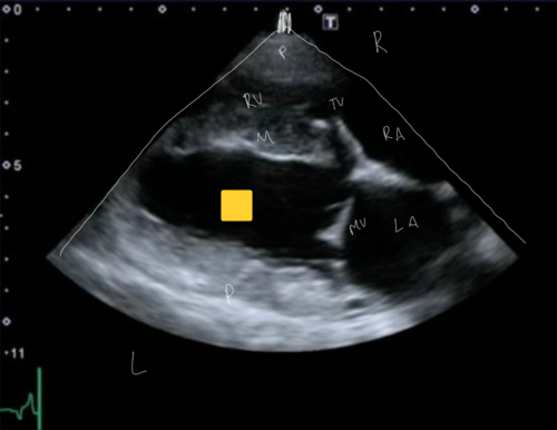 <p>Right Parasternal Long Axis View</p>