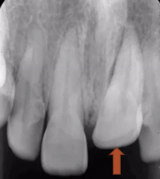<p>tooth travels apically into the socket</p><ul><li><p>poorest prognosis</p></li><li><p>high degree of damage to neurovascular bundles at apex of tooth, which gets squashed</p></li></ul><p></p>
