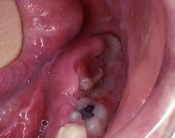 <p>Clinical features of osteosarcoma </p>
