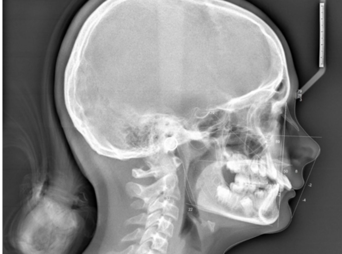 <p>Maxillary incisors are?</p>