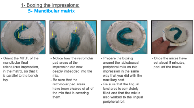 <p>Retromolar pad should be deeply imbedded into the mix but completely exposed (be sure that the retromolar pad areas have been cleared of all of the mix that is covering them)</p>