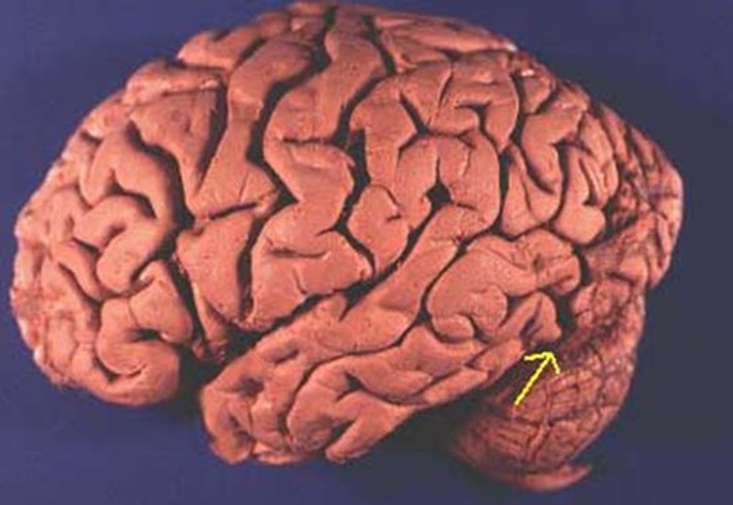 <p>Divides Temporal and Occipital lobes</p>
