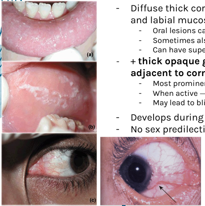 <p>-diffuse thick corrugated or velvety white plaques of buccal and labial mucosa</p><p>-oral lesions can resemble white sponge nevus or leukoedema</p><p>-sometimes also floor of mouth, lateral tongue</p><p>-can have superimposed candidal infection (thrush)</p><p>-<strong>+thick opaque gelatinous plaques of conjunctivae adjacent to cornea</strong>- most prominent in spring, regress in summer/fall, when active → tearing, photophobia, itching of eyes, may leads to blindness</p>