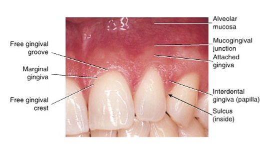 <ul><li><p>observed clinically as small pinpoint depressions, which give the surface of the attached gingiva an orange-peel appearance</p></li></ul><p></p>