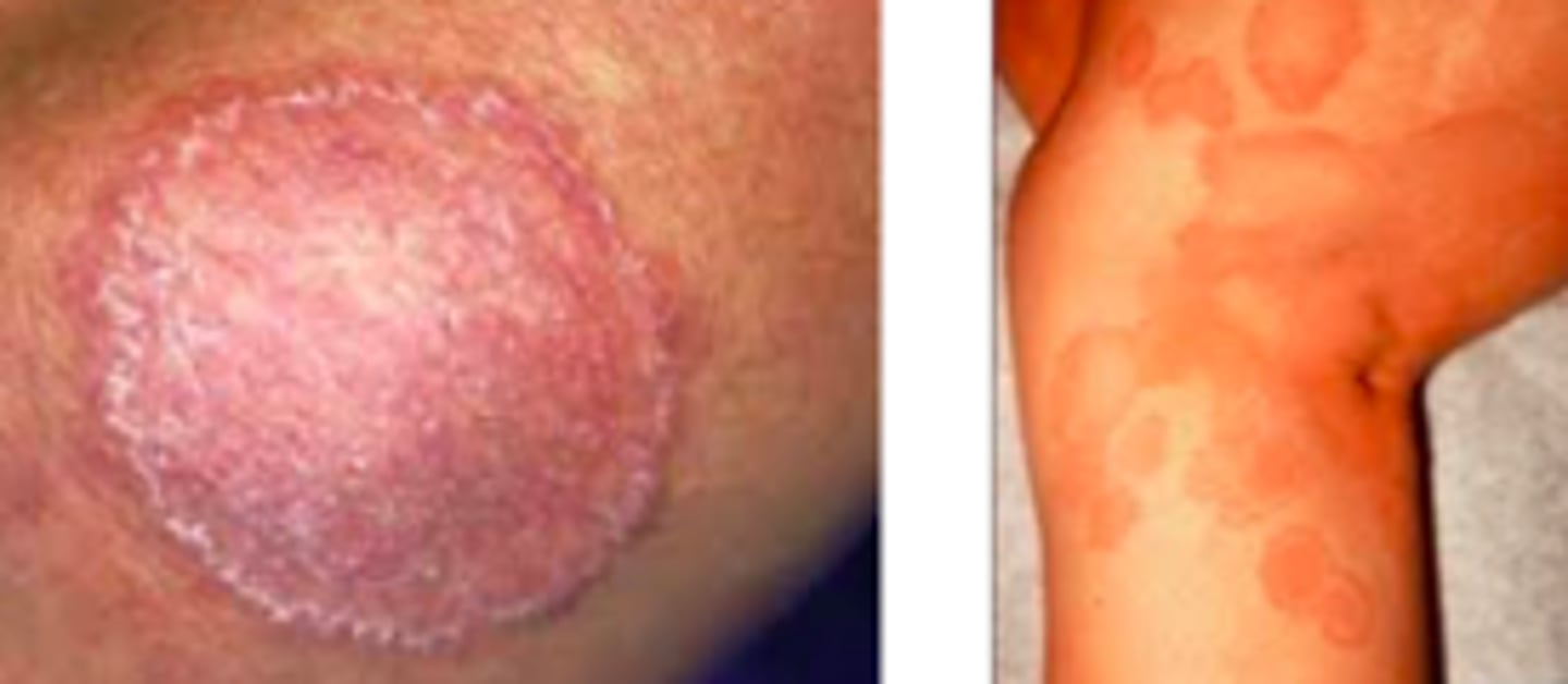 <p>Fungal ID:</p><p>- Often begins are pruritus, circular/oval, erythematous or hyperpigmented, scaling patch or plaque that spread centrifugally</p><p>- Central clearing follows which an active, advancing, raised border remains</p><p>- “Ringworm” due to ring-shaped plaque</p><p>- Multiple plaques could coalesce and pustules occasionally appear</p>