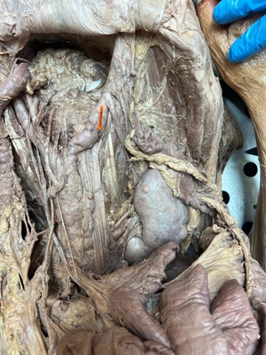 <p>l-r common iliac vain</p>