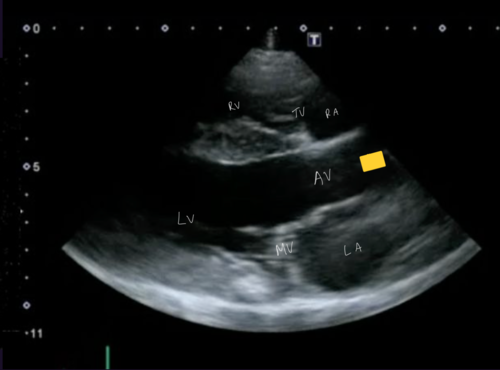 <p>Right parasternal 5 chamber view</p>
