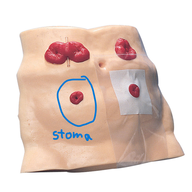 <ul><li><p>ostomy- opening or outlet through abdominal wall for eliminating waste</p></li><li><p>the “opening” is called a stoma</p></li><li><p>can be temporary or permanent</p><p></p></li></ul><p></p>