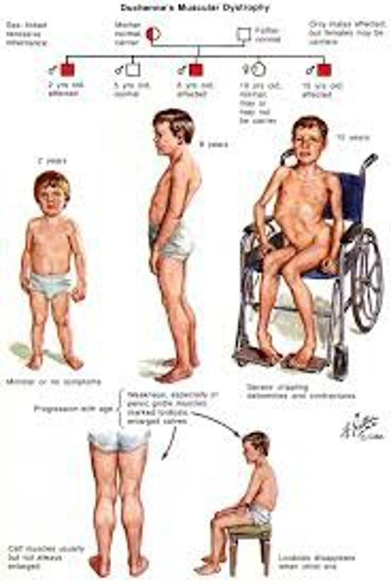 <p>Becker muscular dystrophy (X-linked missense mutation in dystrophin, less severe than Duchenne)</p>