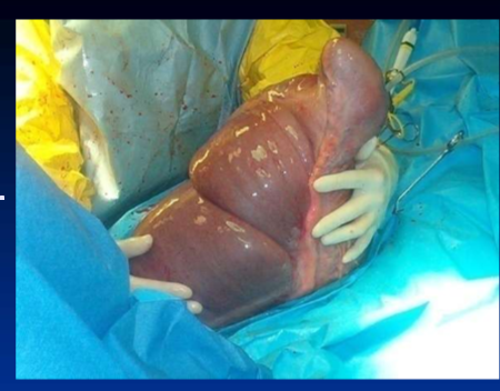 <ul><li><p>firm ingesta filling cecum </p></li><li><p>risk factors / <strong>predispositions as with LC impaction but </strong></p></li><li><p>some are associated with <strong>orthopedic sx, prolonged hospitalization and NSAID use and </strong></p></li><li><p>some may involve a primary <strong>motility disorder </strong></p></li><li><p>diagnosis by abdominal palpation per rectum </p></li><li><p>medical tx if early; <strong>aggressive fluids and laxatives </strong></p></li><li><p><strong>surgery sooner rather than later; </strong>spontaneous perforation with minimal premonitory signs can occur </p><ul><li><p>typhylotomy and evacuation </p></li></ul></li><li><p>true motility disorder is considered a progressive condition that will culminate in cecal rupture without surgery; cecal bypass via ileocolostomy </p></li></ul><p></p>