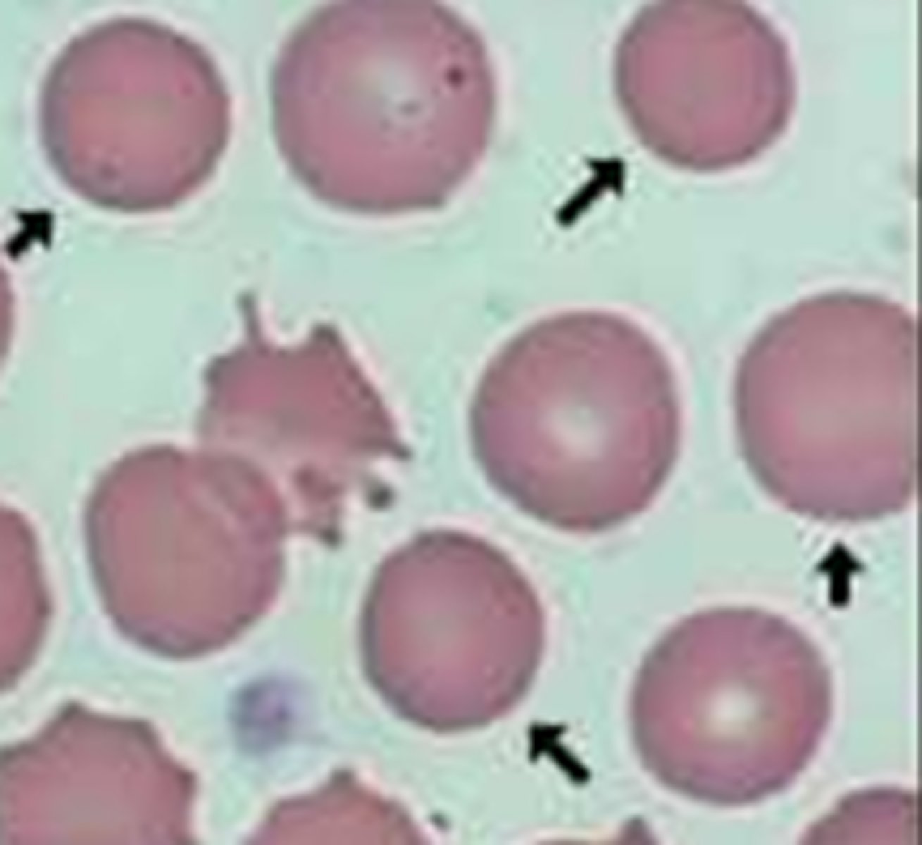 <p>central pallor less than ⅓ (high Hb proportionally) IN SPHEROCYTES</p>