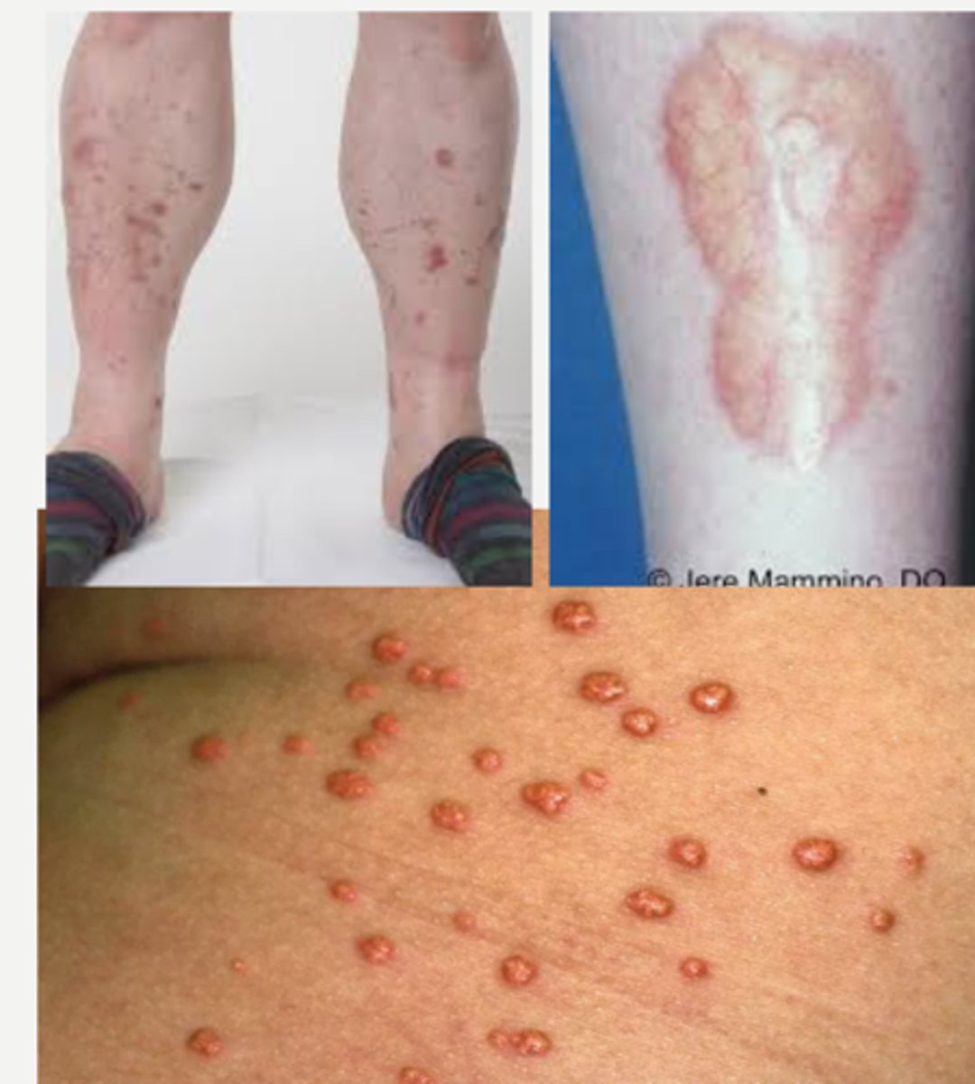 <p><strong><span style="text-decoration:underline">Diabetic Dermopathy</span></strong>= <em>round/oval atrophic hyperpigmented macules in pretibial areas bilaterally </em></p><p></p><p>other common derm findings:</p><p>-<strong>Xanthoma Eruptiva</strong> (<em>pink papules with creamy center due to elevated TGs</em>)</p><p>-<strong>Necrobiosis Lipodica Diabeticorum </strong>(<em>degenerative disease of collagen characterized by atrophic waxy telangiectatic plaques or fluid filled bullae on hands and feet</em>)</p>