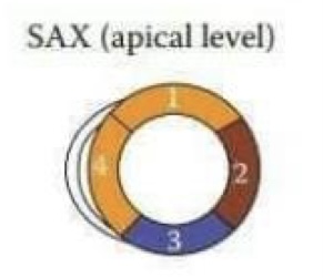 <ol><li><p>Anterior (LAD)</p></li><li><p>Lateral (LCx)</p></li><li><p>Inferior (RCA)</p></li><li><p>Septal (LAD)</p></li></ol>