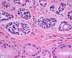 <p>Cerumen-gland adenocarcinoma</p><p>Atypical glands lined by several layers of atypical cells, show solid areas &amp; invasive pattern.</p>