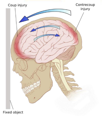<p>AKA Coup-Contrecoup</p><ul><li><p>head set into motion by physical forces</p></li><li><p>affecting entire tissue - front and back of brain - strains - stressing/straining on white matter fibres</p></li></ul><p></p>