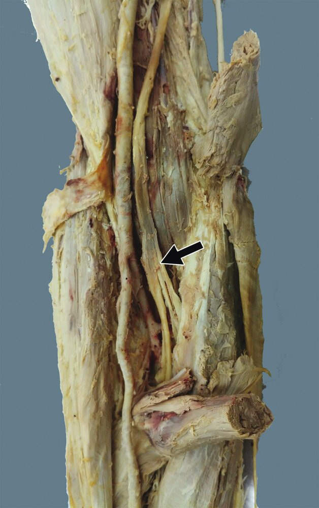 <p>18. The image shows a macroscopic specimen of the elbow, in which a nerve marked by an arrow has been exposed.</p><p>What is the most likely function of the muscles innervated by the nerve marked with the arrow?</p><p>A. Internal rotation of the shoulder joint</p><p>B. Supination in the radioulnar joints</p><p>C. Ulnar abduction at the proximal wrist joint</p><p>D. Flexion at the proximal wrist joint</p><p>E. Extension in the metacarpophalangeal joints of digits 4 and 5</p>