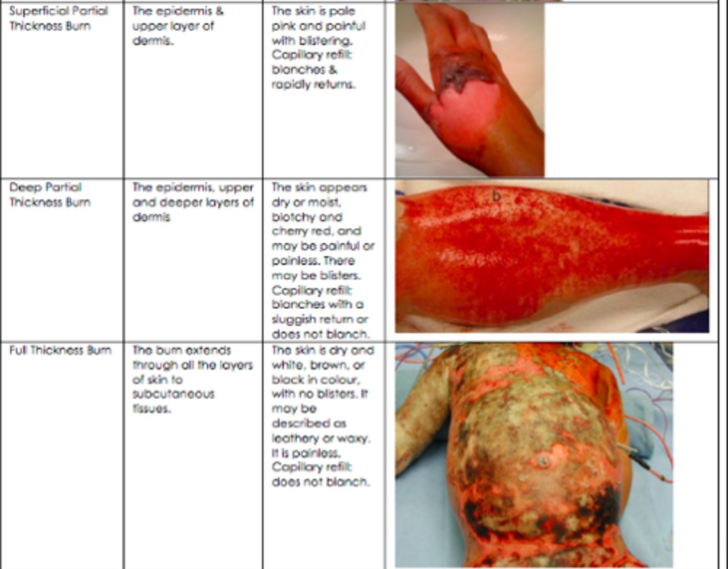 <p>burns through the epidermis, upper, and deeper layers of the dermis</p><p>skin is dry or moist, blotchy, or cherry red and may be painful or painless. may be blisters. cap refill blanches with a sluggish return or does not blanch.</p>