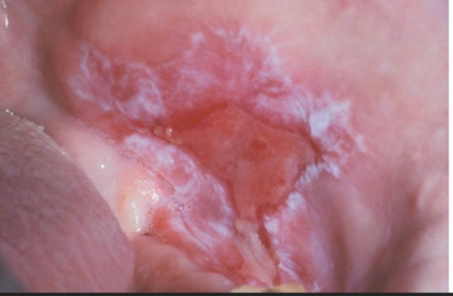 <p>Hint: ulceration with bordered periphery of white radiating striae</p>