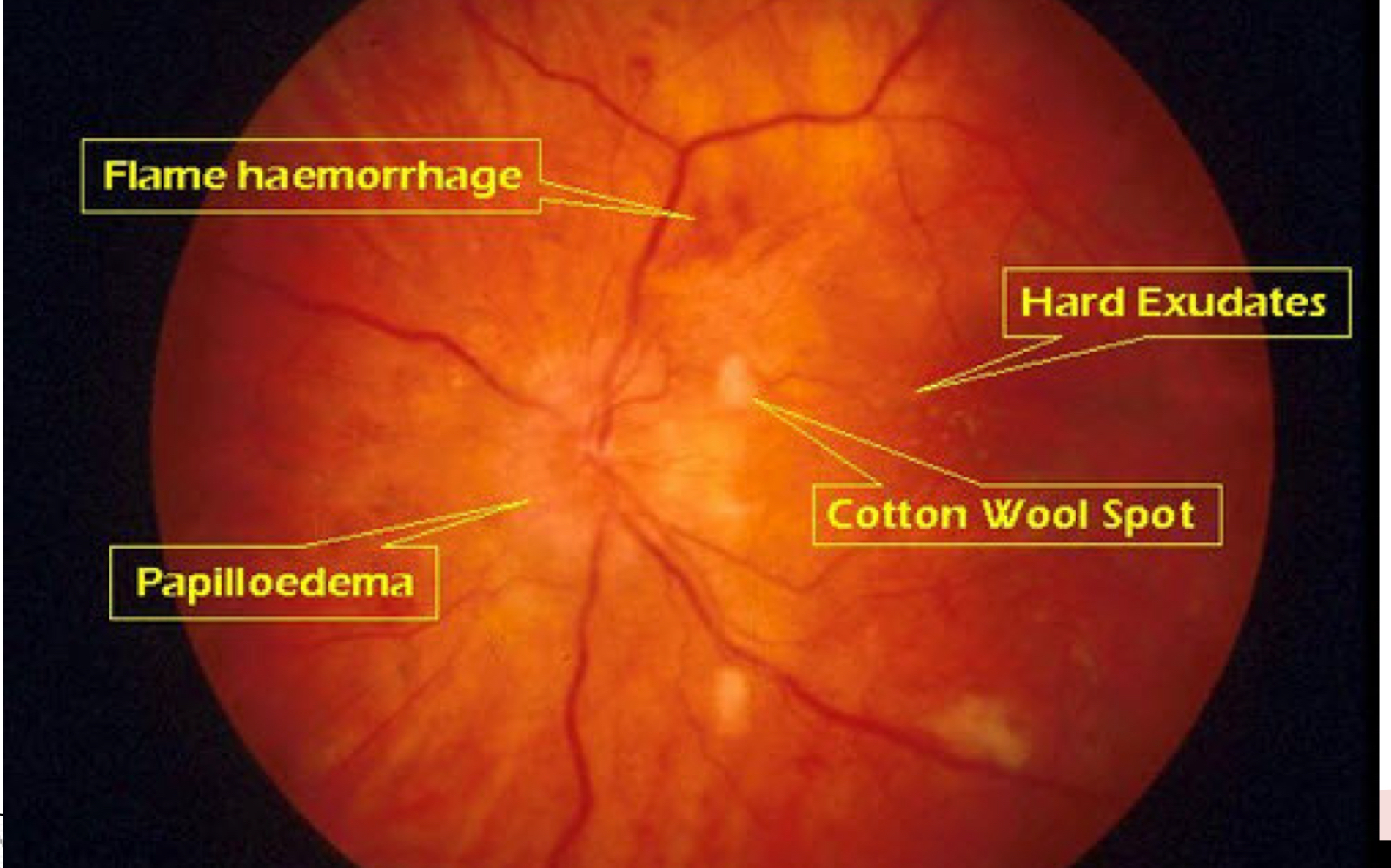 <p>Which type of retinopathy is this?</p>