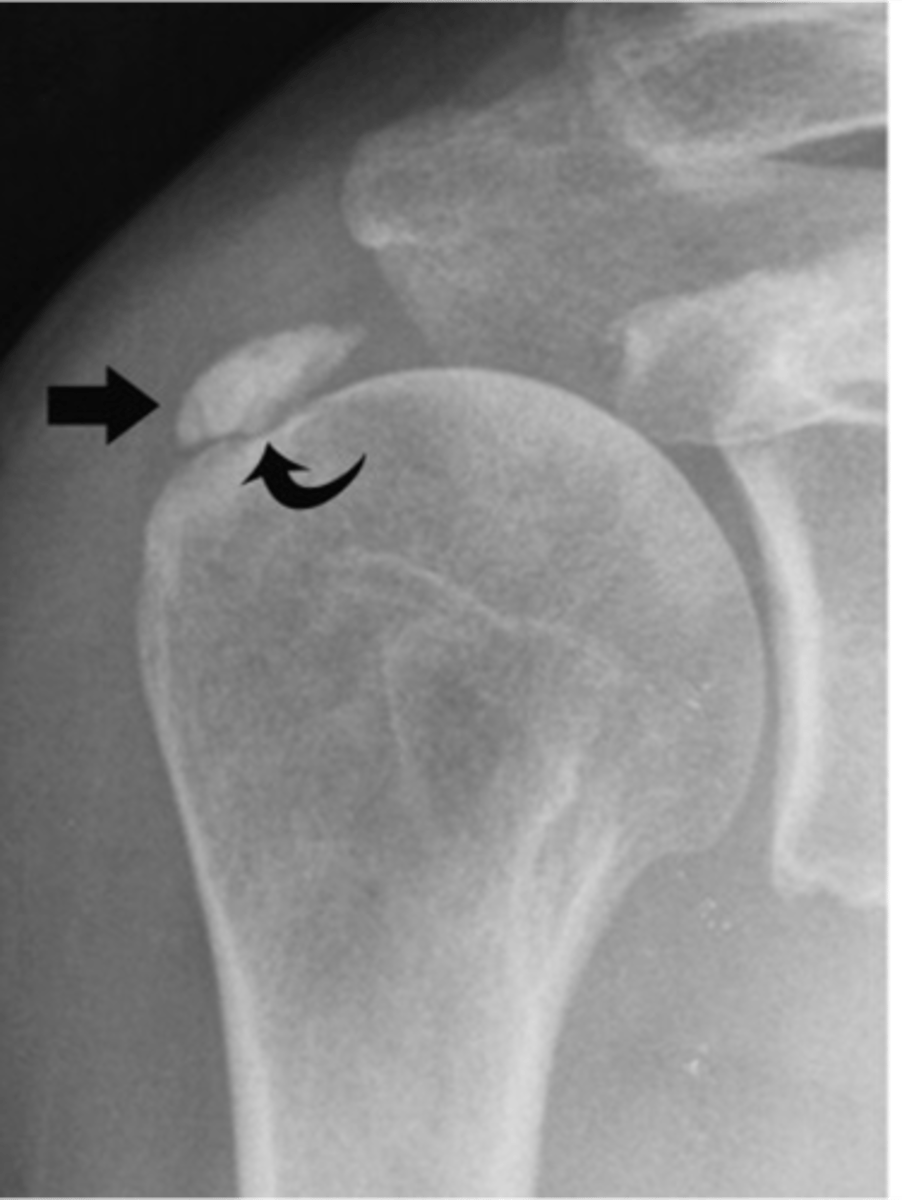 <p>State the clinical features of hydroxyapatite deposition disease (HADD)</p>