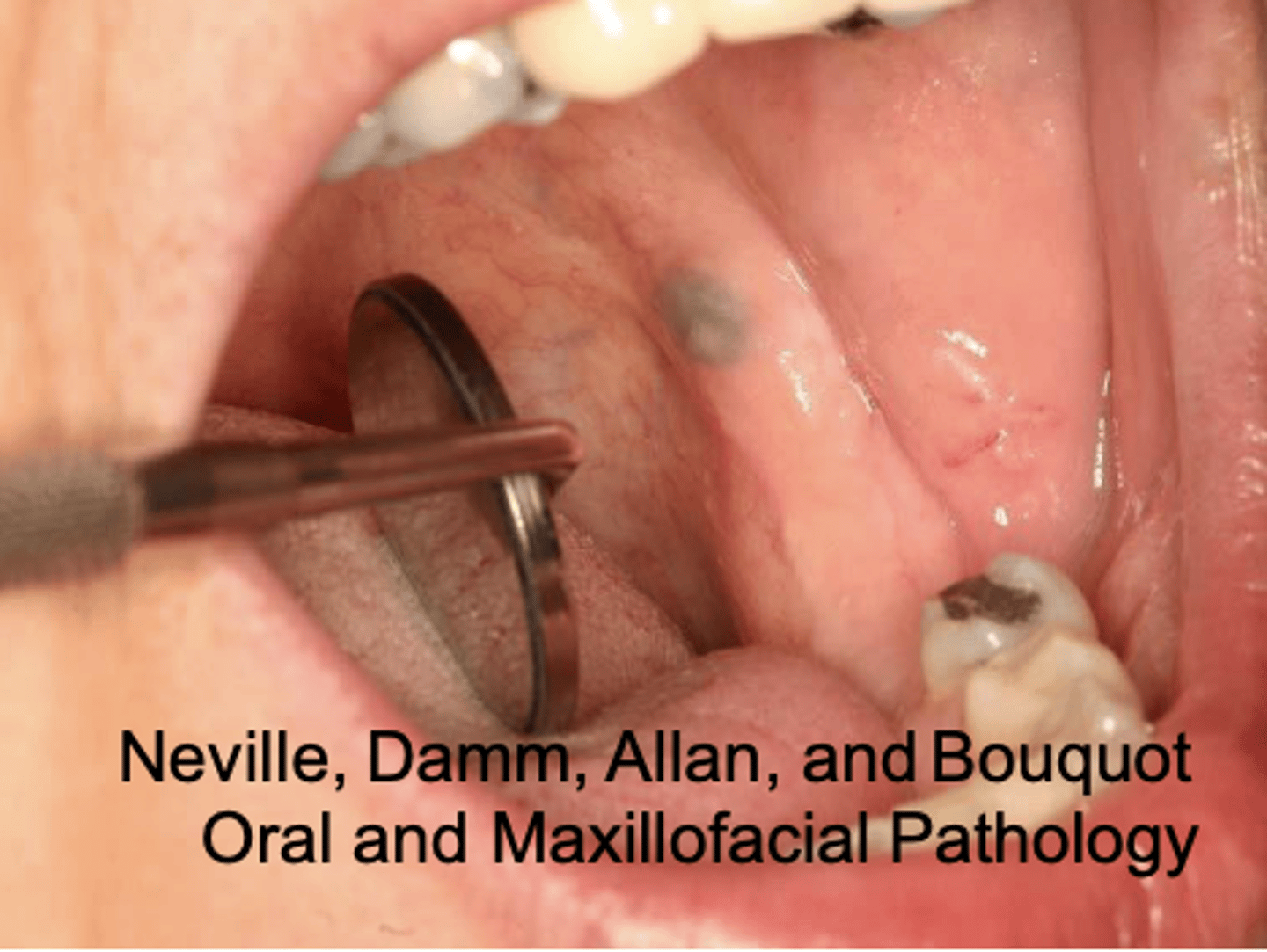 <p>What type of pigmented lesion?</p>