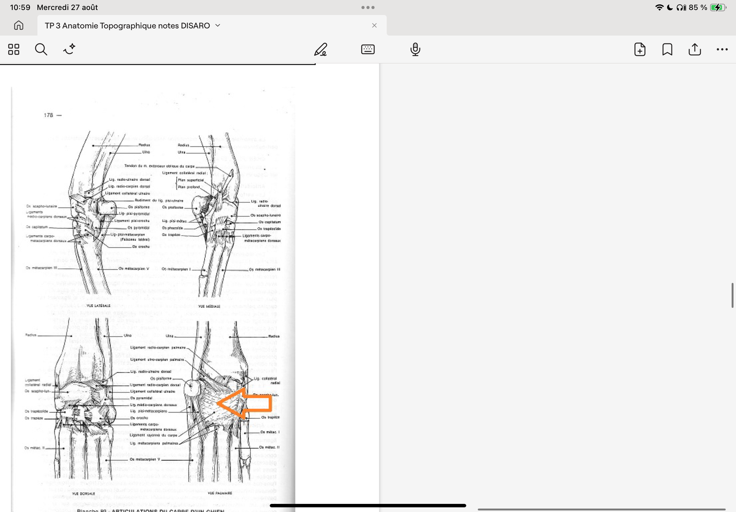 <p>Fracture de l’os accessoire: L’os accessoire présente un collet en son milieu, ce qui le prédispose à la fracture.</p><p>Possibilités de traitement: Chirurgie</p>