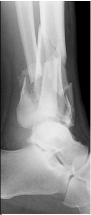<p>Would you describe this fracture as comminuted or segmental?</p>