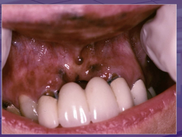 <p>what is the dx </p><p>amalgam tattoo </p><p>melanotic macule </p><p>melanoma </p><p>melanocytic nevus </p>