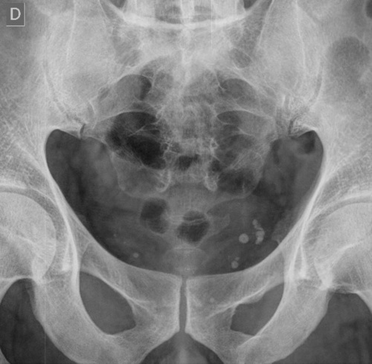 <p>small blood clots in a vein that calcify over time, usually incidental finding, lucent centers</p>